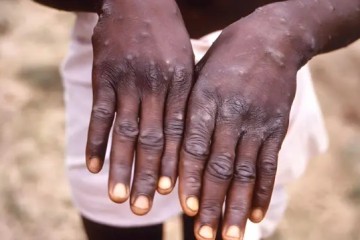 Épidémie de Mpox (variole du singe) au Nigeria : 39 cas signalés sans décès, alerte internationale déclenchée